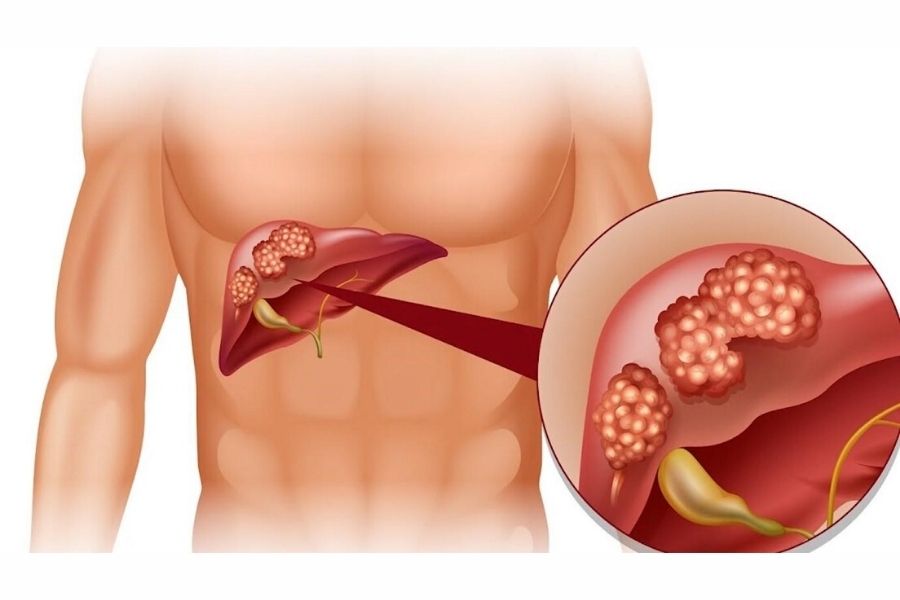 Bệnh viêm gan có thể gặp ở nhiều người
