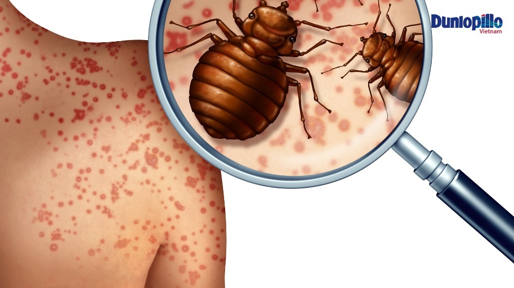 Rệp giường là gì, từ đâu mà có? Vết rệp giường cắn trông như thế nào? 3 Bị rệp giường cắn sẽ nổi đỏ